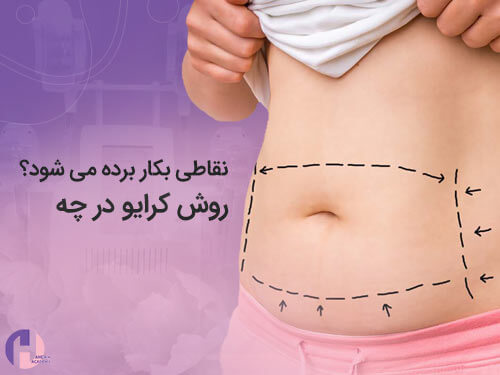 تصویر روش کرایو در چه نقاطی بکار برده می شود