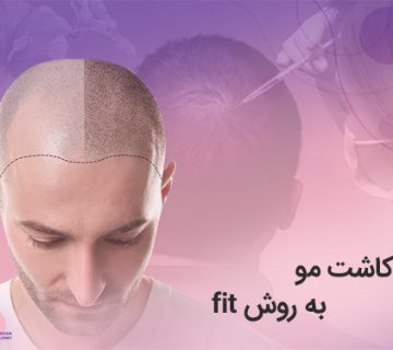 تصویر کاشت مو به روش fit