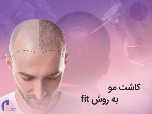 تصویر کاشت مو به روش fit