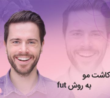تصویر کاشت مو به روش fut