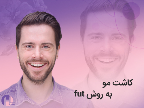 تصویر کاشت مو به روش fut