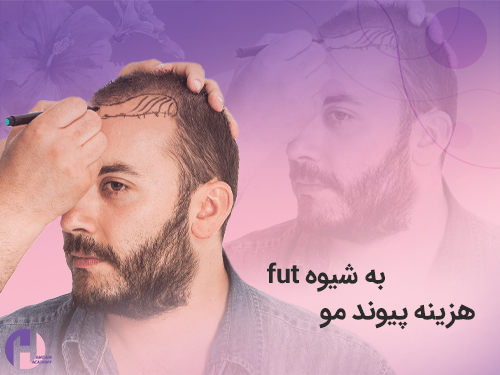 تصویر هزینه کاشت مو به شیوه fut