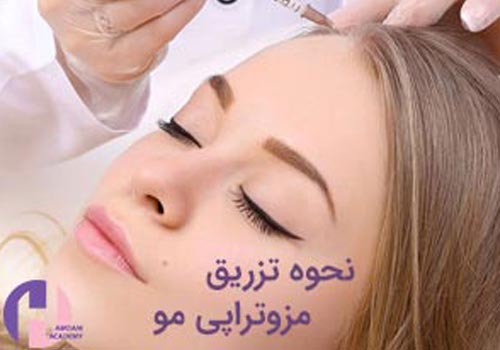 تصویر نحوه تزریق کوکتل مزوتراپی مو