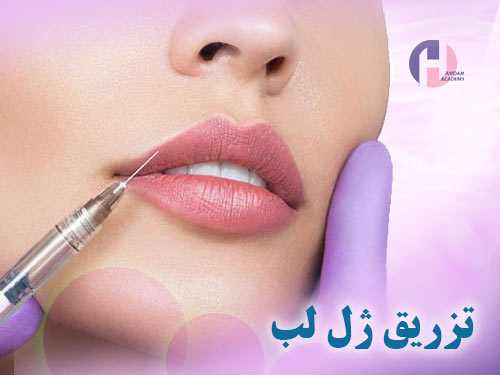 تصویر تزریق ژل لب