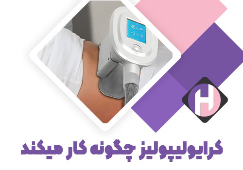 تصویر کرایولیپولیز چگونه کار می کند
