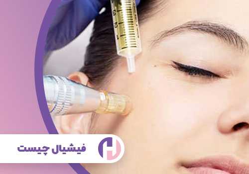 تصویر فیشیال چیست