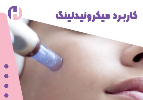 تصویر کاربرد میکرونیدلینگ