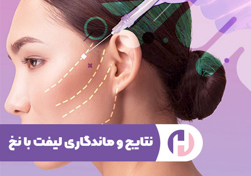 تصویر نتایج و ماندگاری لیفت با نخ