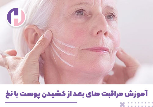 تصویر آموزش های مراقبت بعد از کشیدن پوست با نخ