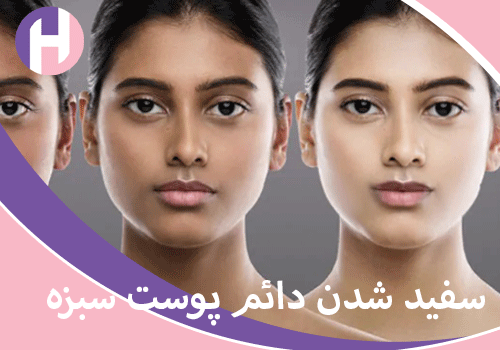 تصویر سفید شدن دائم پوست سبزه