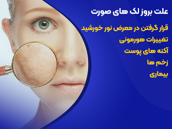 علت بروز لک‌های صورت