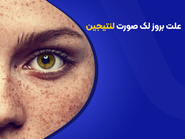 علت بروز لک های لنتجین
