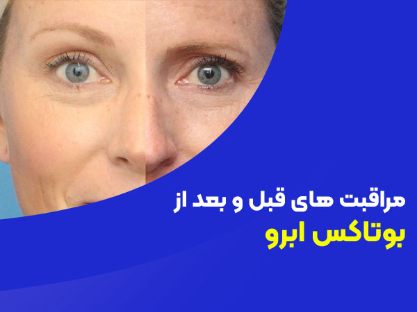 مراقبت های مورد نیاز بوتاکس ابرو